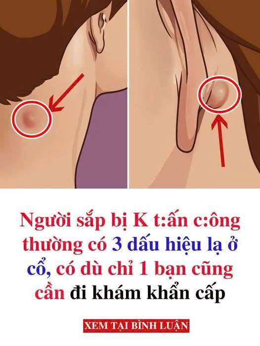 Người sắp bị UT thường có 3 dấu hiệu lạ ở cổ, có dù chỉ 1 bạn cũng cần đi khám khẩn cấp